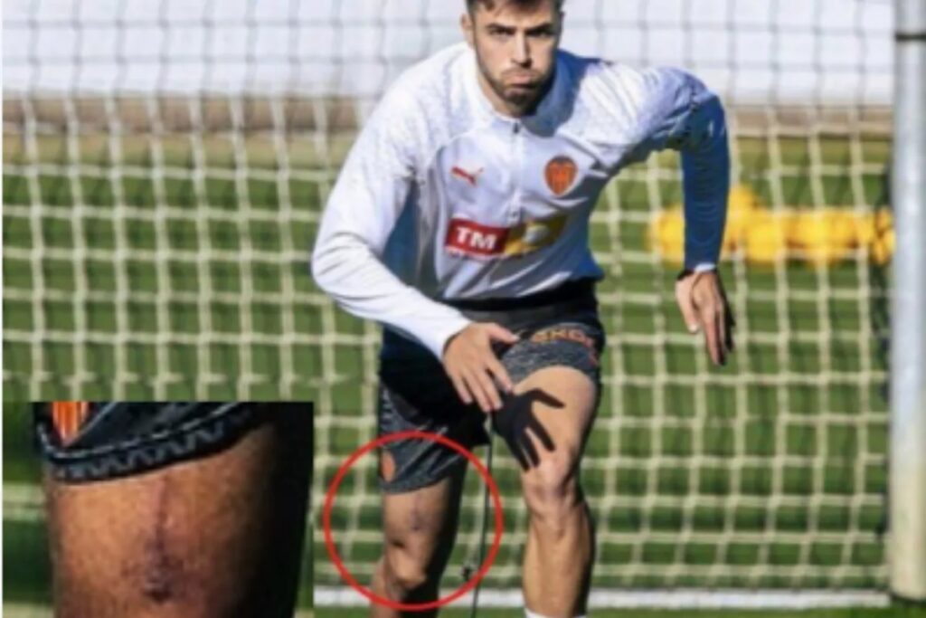 Valencia CF: La ‘herida de guerra’ de Alberto Mar… para ir con cuidado